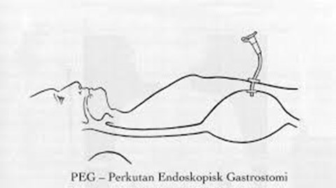 PEG